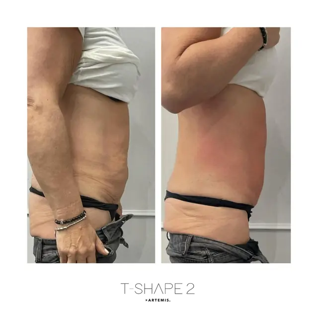 T-Shape 2 result — Abs 1