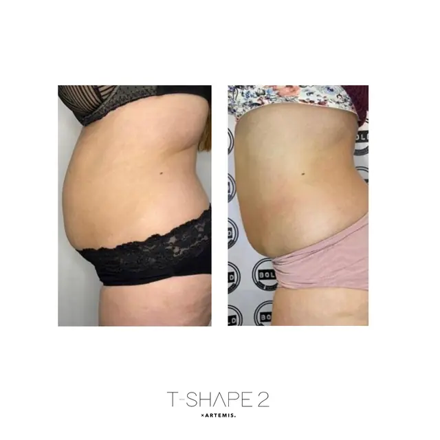 T-Shape 2 result — Abs 4