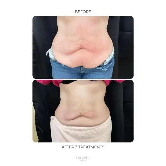 T-Shape 2 result — After 3 treatments (3)