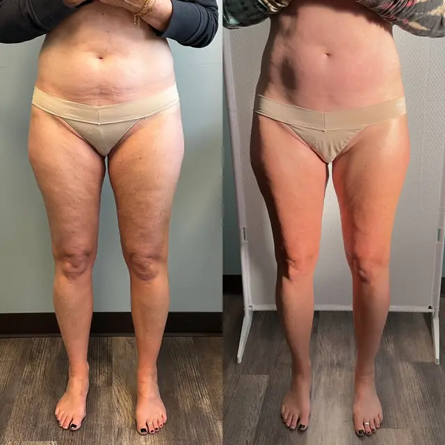 T-Shape 2 result — After 3 treatments (front)