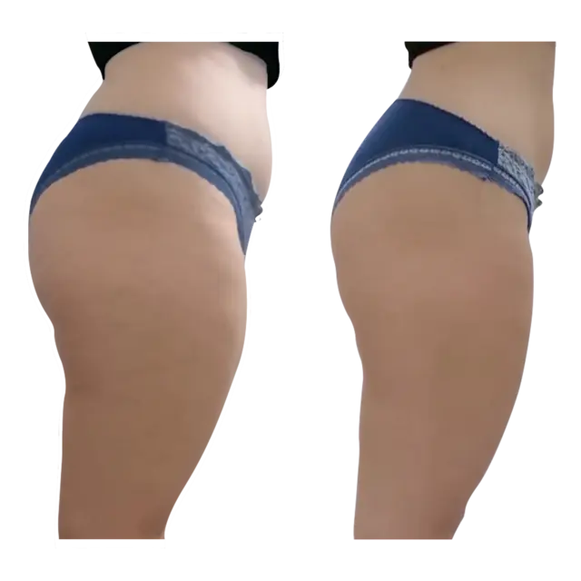 T-Shape 2 result — After 3 treatments (side 1)