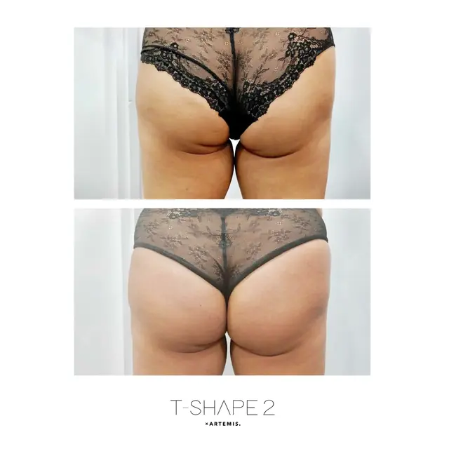 T-Shape 2 result — Glutes 1