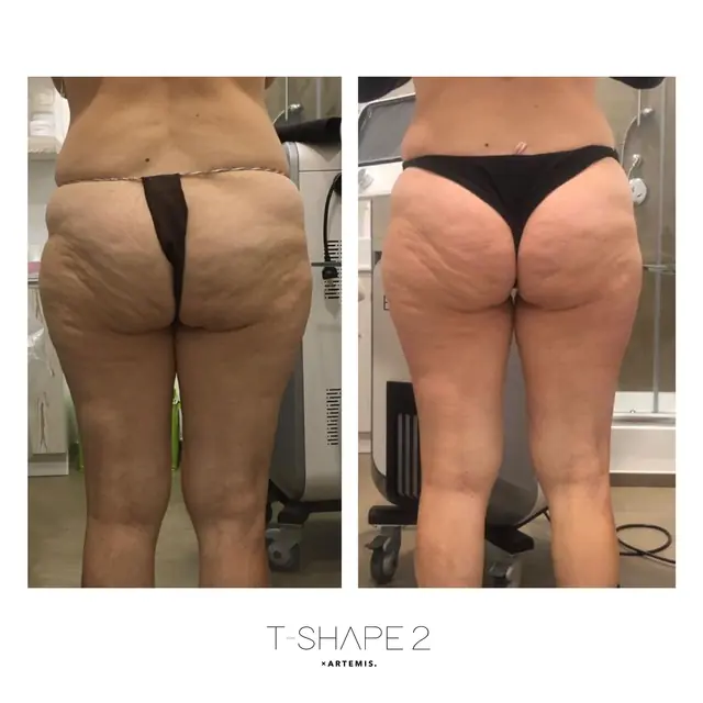 T-Shape 2 result — Legs 4