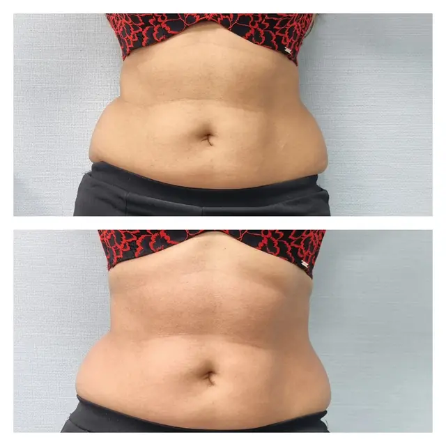 T-Shape 2 result — T shape2 after 1 front permission to use